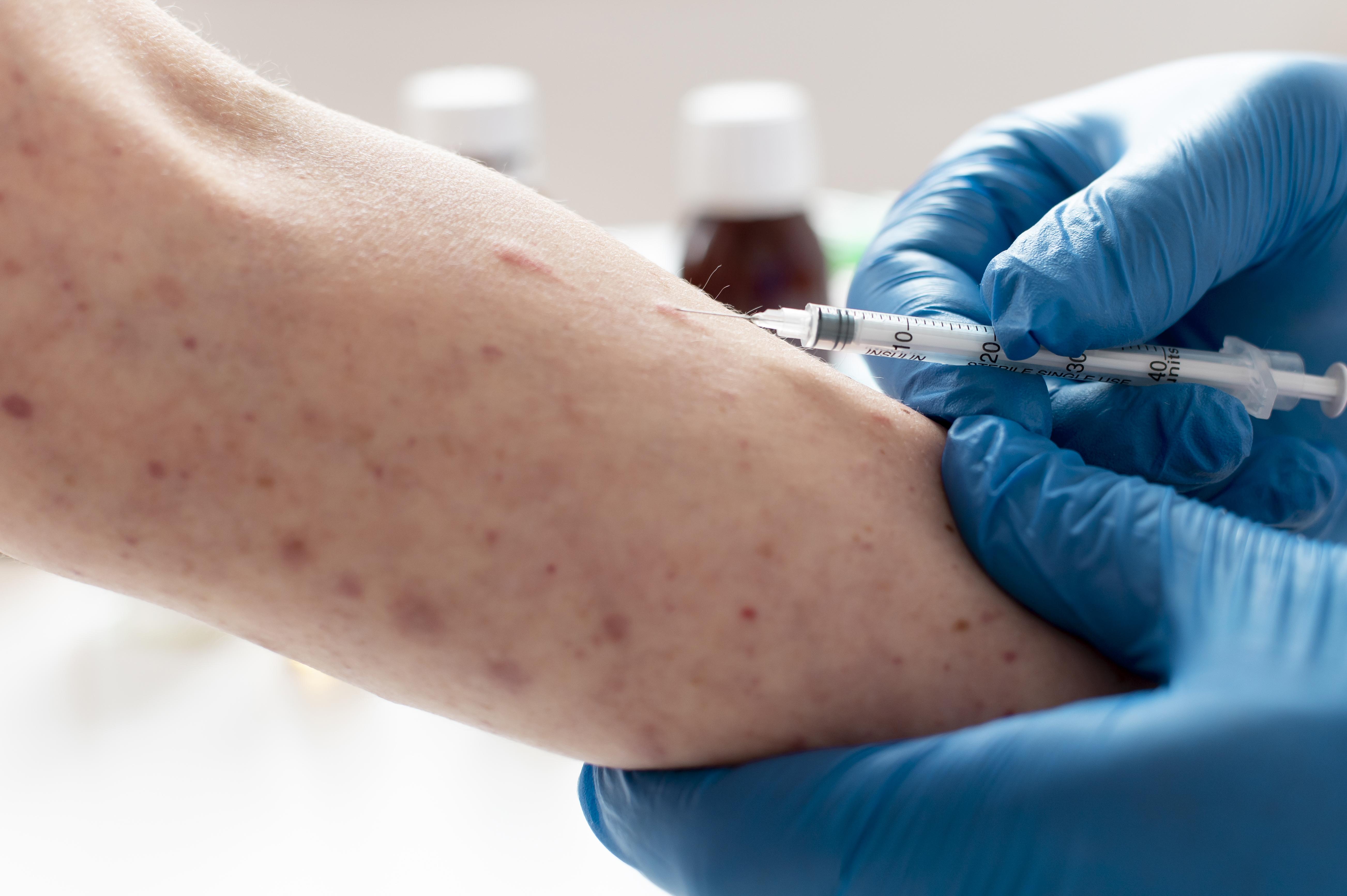Measles Elimination Status Loss of Canada Alarms Health Experts